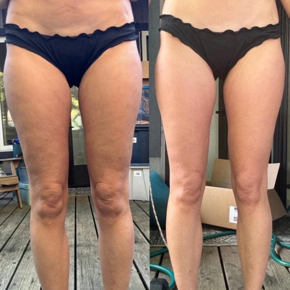 EasyLift™ - Anti-Cellulite Massager